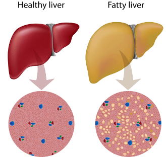 健康の肝臓と脂肪肝　コリンエステラーゼが影響